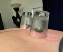 Cupping_101_02_Poor_Mans_Set_of_Fire_Cups.jpg
